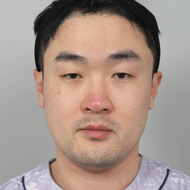 #部分切開 #目つき矯正 #鼻筋（シリコン） #鼻先（自家軟骨）