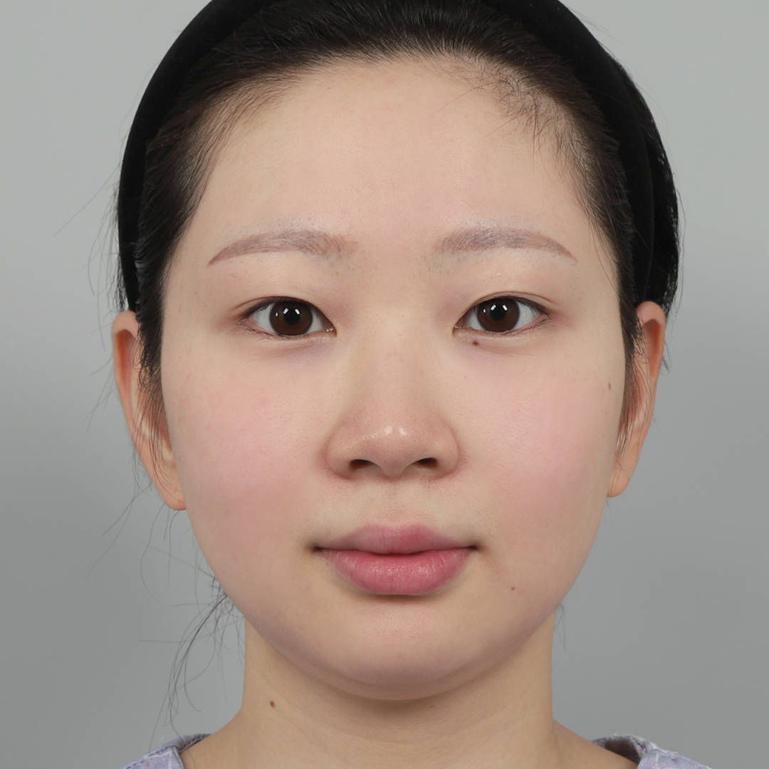 #鼻筋（シリコン） #鼻先（自家軟骨）