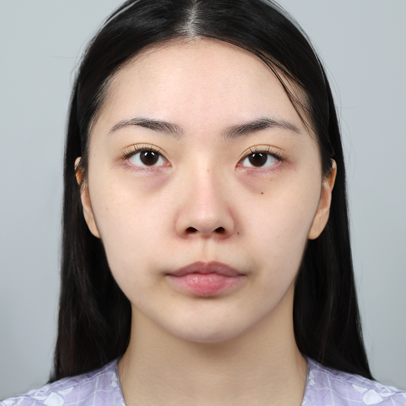 #目の下の脂肪再配置 #顔の脂肪移植フルフェイス脂肪移植