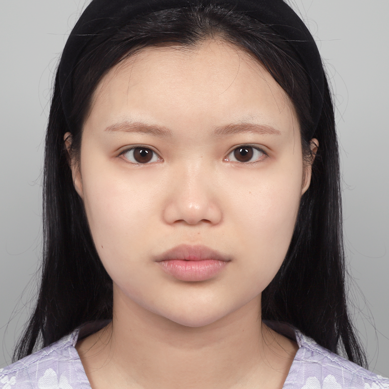 #鼻筋（シリコン）#鼻先（自家軟骨）#短い鼻（アップノーズ）矯正