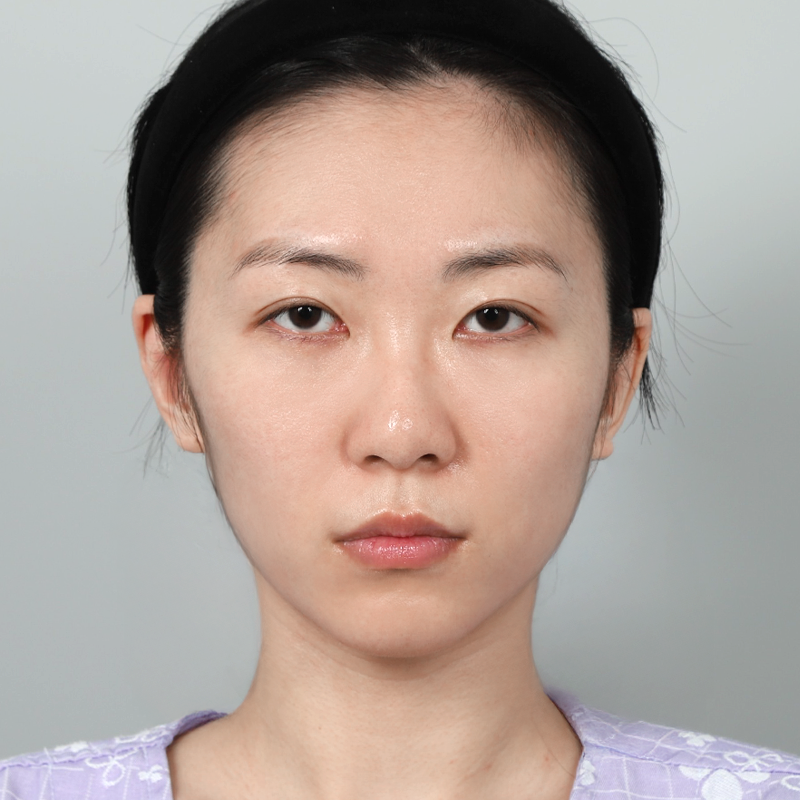 #顔の脂肪移植 #鼻筋（シリコン） #鼻先（自家軟骨） #自家肋軟骨鼻整形フルフェイス脂肪移植