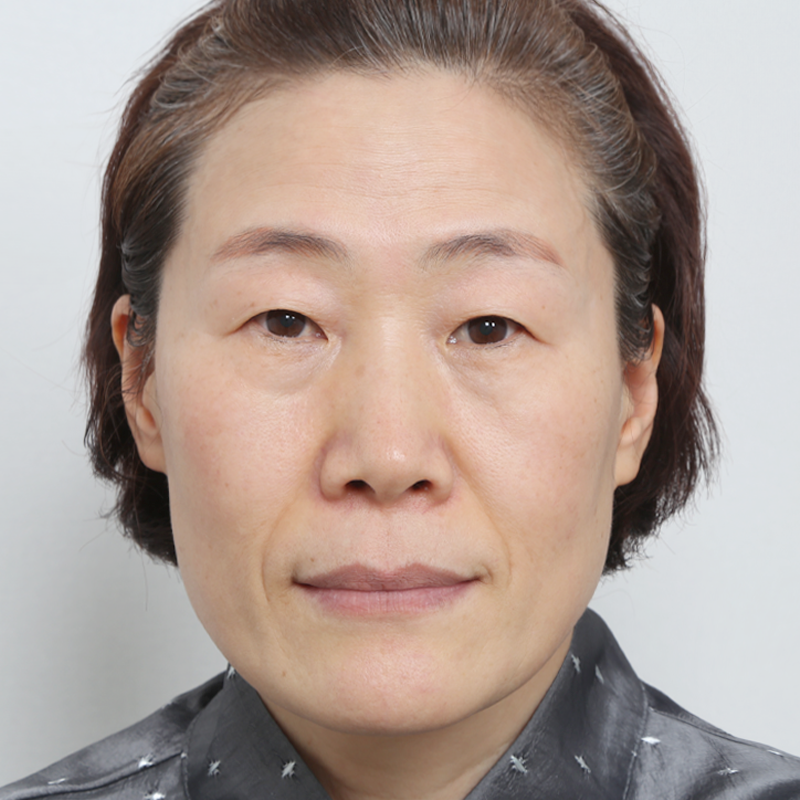 #切らない（埋没法）#目尻切開＋グラマラスライン形成#下眼瞼切開