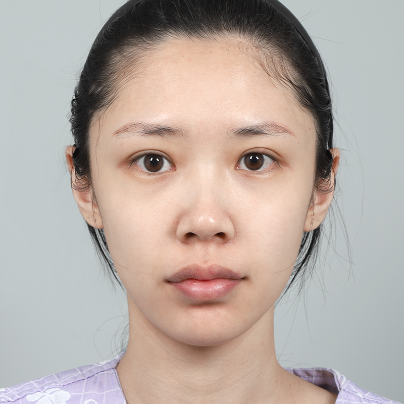 #鼻筋（シリコン） #鼻先（自家軟骨）