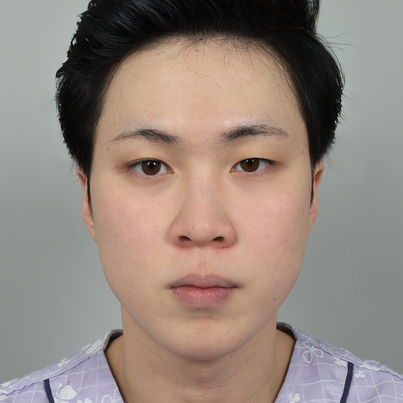 #部分切開 #目つき矯正 #鼻筋（シリコン） #鼻先（自家軟骨）