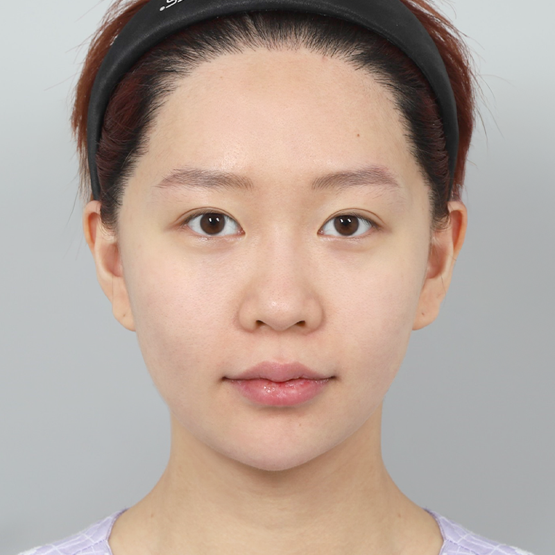 #鼻筋（シリコン）#鼻先（自家軟骨）#福鼻矯正