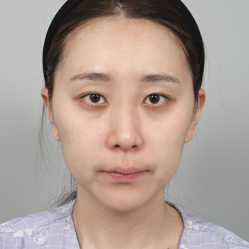 #部分切開 #眼瞼下垂矯正 #目の下の脂肪再配置 #プロテーゼなしの鼻整形 #鼻先(自家軟骨)