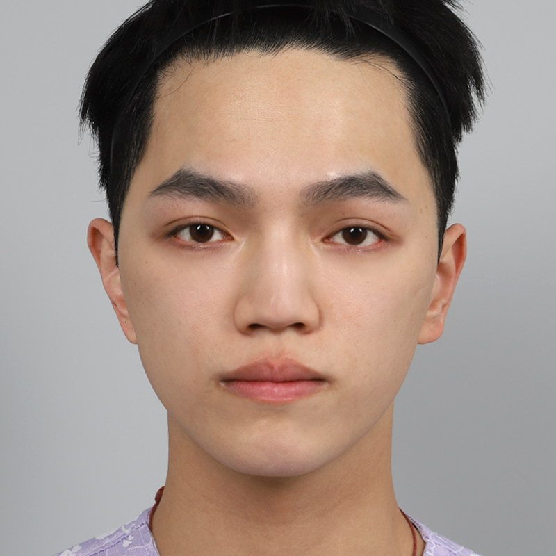 #鼻筋（シリコン） #鼻先（自家軟骨） #自家肋軟骨鼻整形 #鷲鼻矯正