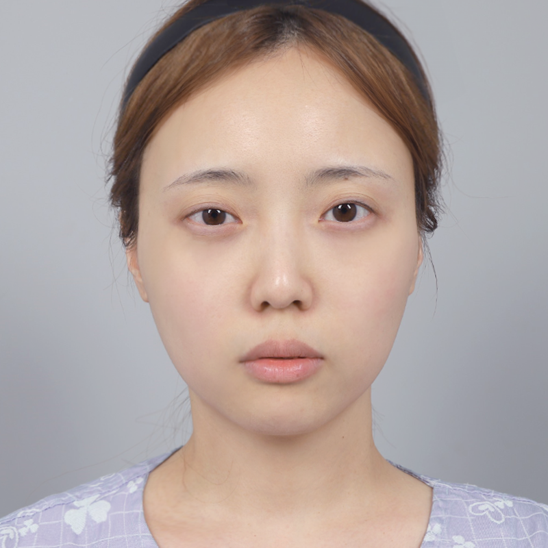 #部分切開 #目頭切開 #目の上の脂肪移植 #目つき矯正