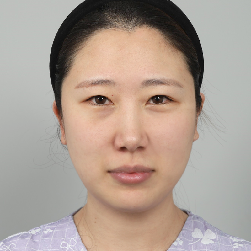 #完全切開 #目尻切開 #目頭切開 #上眼瞼脱脂 #下眼瞼脂肪再配置 #目頭切開再手術