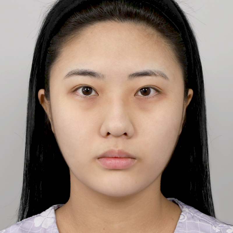 #鼻筋（シリコン） #鼻先（自家軟骨） #自家肋軟骨鼻整形