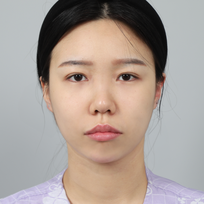 #鼻筋（シリコン）#鼻先（自家軟骨）#部分切開#目頭切開#垂れ目形成