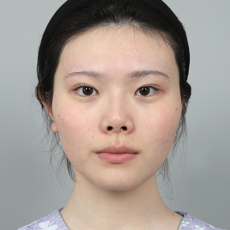 #鼻筋（シリコン） #鼻先（自家軟骨） #自家肋軟骨による鼻整形 #短い鼻（アップノーズ）矯正