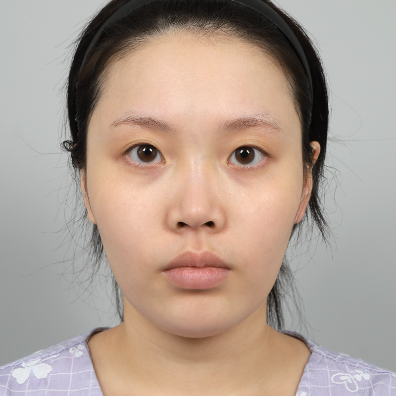 #部分切開 #鼻筋（シリコン） #鼻先（自家軟骨）