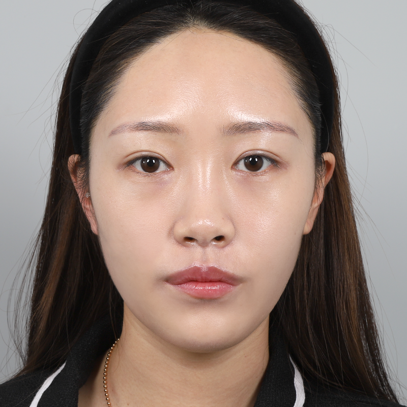 #鼻筋（シリコン） #鼻先（自家軟骨） #目の下の脂肪再配置フルフェイス脂肪移植