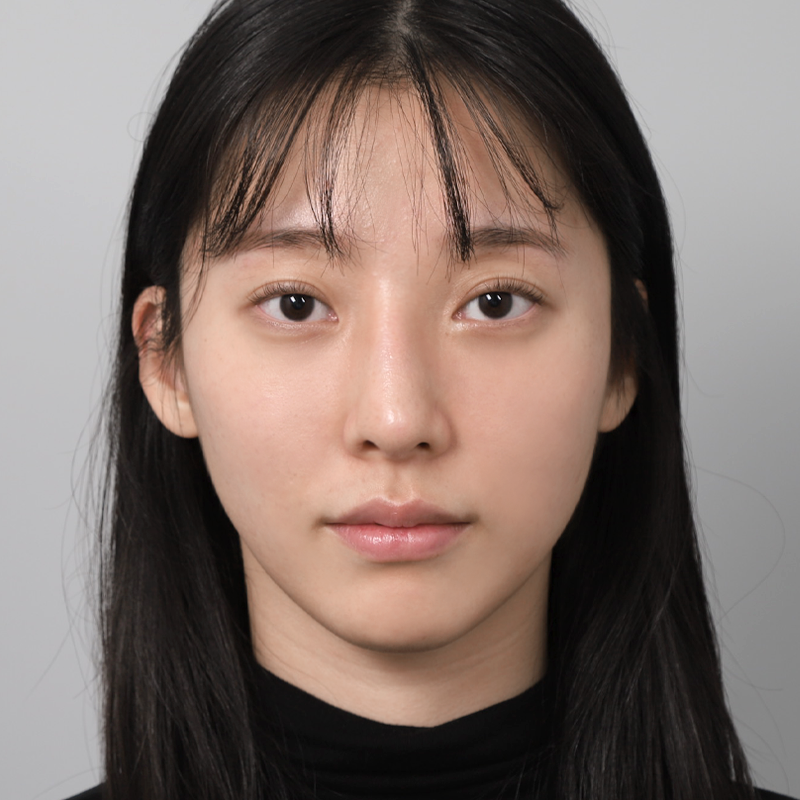 #鼻先(自家軟骨) #プロテーゼなし鼻整形 #わし鼻矯正 #鼻再手術