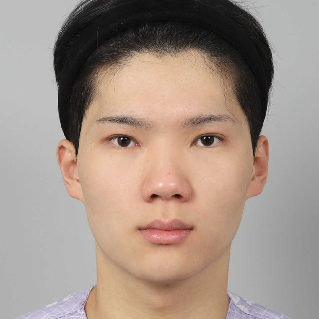 #鼻筋（シリコン） #鼻先（自家軟骨）